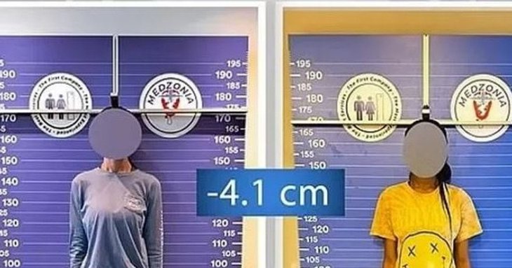 Новий тренд: жінки вкорочують ноги, щоб знайти кохання — фото до і після