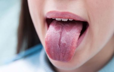 Названо причини появи прищів у роті