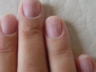 Нігті можуть сигналізувати про приховані хвороби: на яку зміну варто звернути увагу