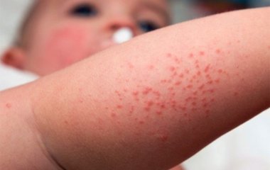Сверблячка під пахвами може бути ознакою 6 захворювань