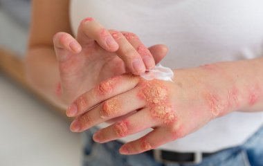 Современный тип питания провоцирует псориаз, данные ученых
