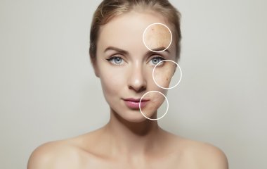 Почему давить прыщи опасно для жизни: ответ врача
