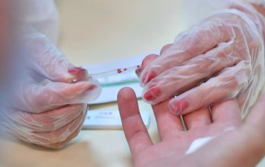 Названо ознаку небезпечного рівня холестерину, помітну на обличчі