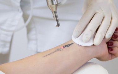 12 нюансів, які ви повинні знати перед видаленням татуювання