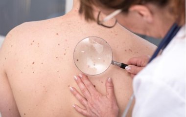 Онколог перерахував ознаки переродження родимки у меланому