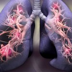 Британские медики назвали «кожные» симптомы рака легких