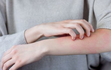 Виявилось, що більшість діагнозів алергії можуть бути хибними — нове дослідження