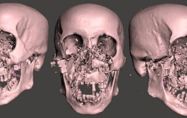 Хірурги врятували чоловіка, якому ведмідь роздер обличчя: який він зараз має вигляд (фото)