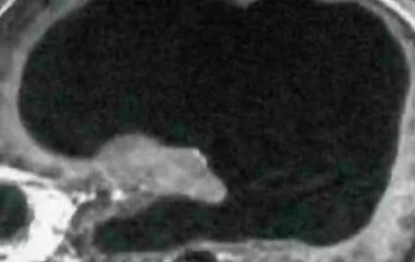 Чоловік випадково виявив, що живе з половиною мозку – фото