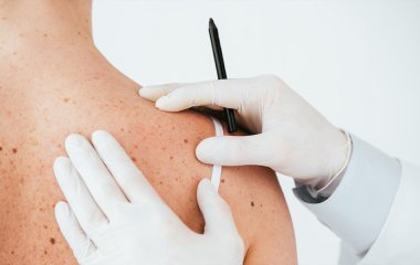 Рак кожи: как выявить и предотвратить опасное заболевание