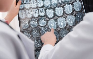 Вчені знайшли спосіб виявити рак мозку на ранній стадії