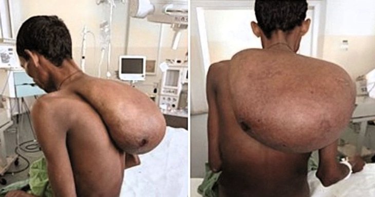 Фермер із гігантською пухлиною на шиї вагою 25 кг впав у депресію та не міг їсти — фото