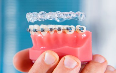 Стоматолог назвала 3 вагомі причини поставити брекети у зрілому віці
