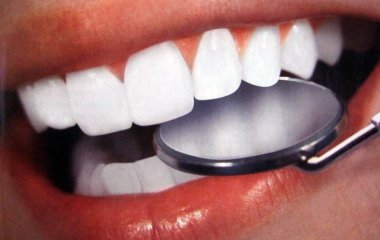 5 головних міфів про відбілювання зубів