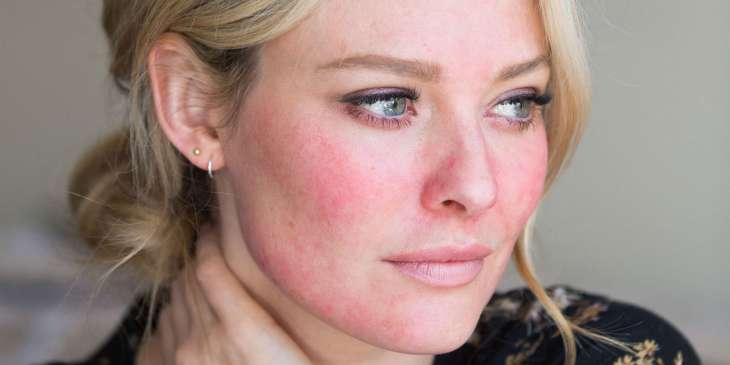 6 способов восстановить обветренную кожу