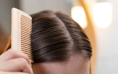 Медик пояснила вплив ГРВІ на рясне випадання волосся