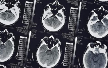 Вчені вигадали ефективний метод виявлення хвороби Альцгеймера