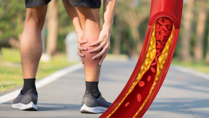 Высокий холестерин: симптом на ногах укажет на опасное состояние