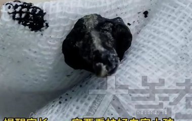 Медики спантеличені знахідкою у носі хлопчика, який два роки скаржився на неприємний запах – фото