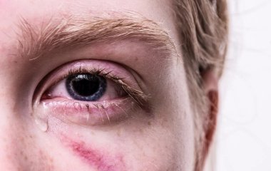 Вчені покращили ефективність антиоксиданту для лікування запалень очей