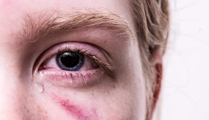 Вчені покращили ефективність антиоксиданту для лікування запалень очей