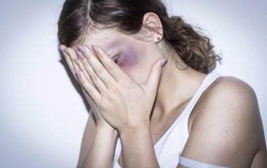 Медики объяснили, чем опасно внезапное появление синяков