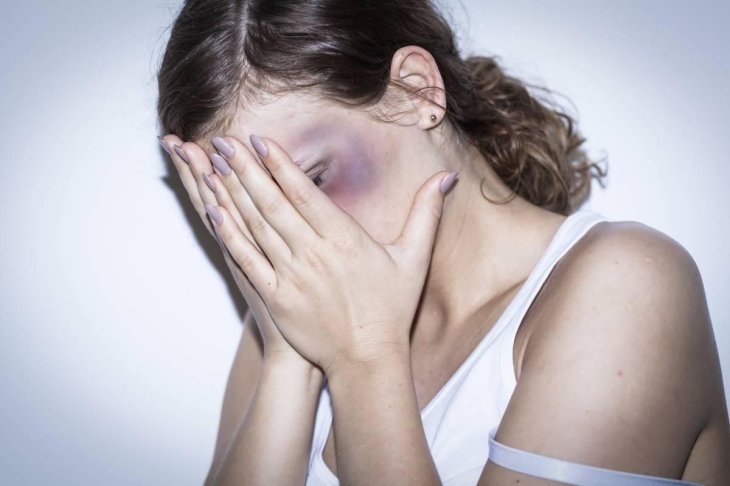 Медики пояснили, чим небезпечна раптова поява синців