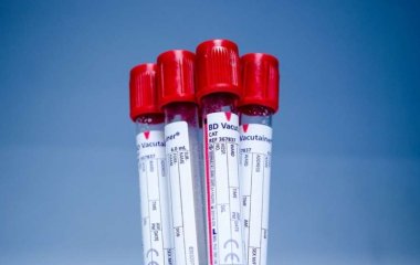 Ученые выяснили, люди с какой группой крови подвержены раннему инсульту