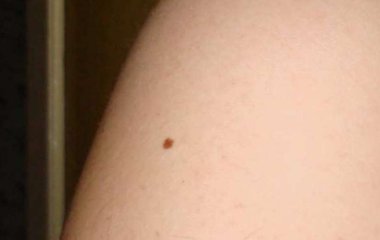 Медики рассказали, что такое гемангиомы и чем они опасны