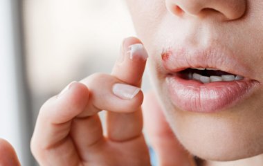 Герпес: чим небезпечний цей вірус та як його уникнути