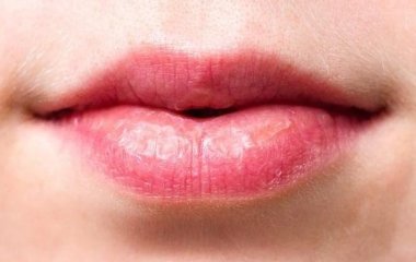 Плями на губах можуть говорити про підвищений рівень холестерину в крові
