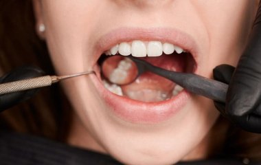 Що не можна робити після імплантації зубів: поради стоматологів