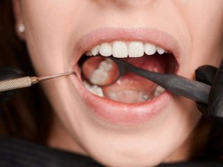 Що не можна робити після імплантації зубів: поради стоматологів