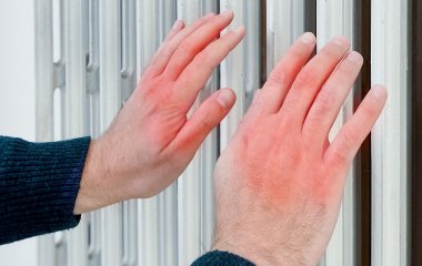 Дерматолог пояснила появу «ковидних пальців» при коронавірусі