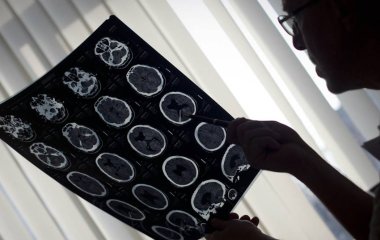 Шизофренію пов'язали з підвищеним ризиком смерті від COVID-19