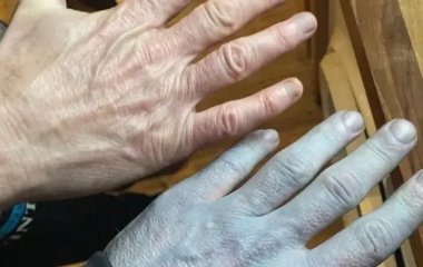 Чоловік прокинувся із синьою шкірою і потрапив до лікарні: несподівана причина здивувала медиків