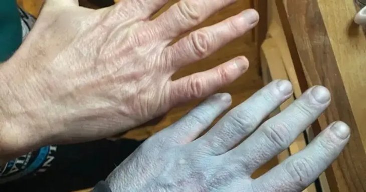 Чоловік прокинувся із синьою шкірою і потрапив до лікарні: несподівана причина здивувала медиків