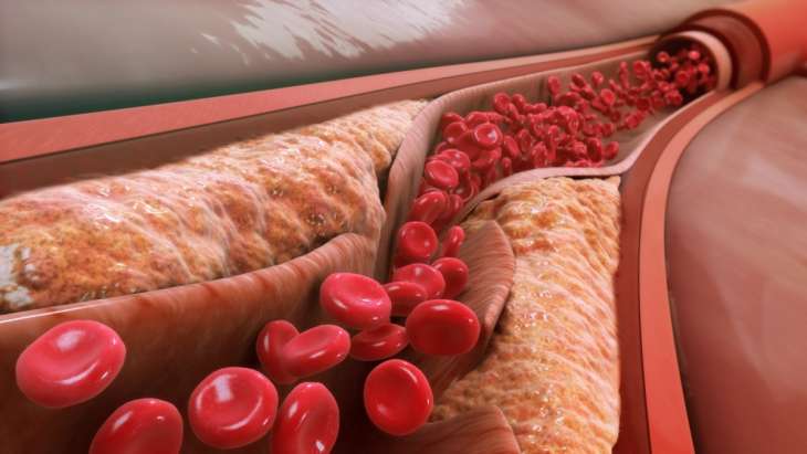 Симптомы атеросклероза: главные признаки плохого состояния артерий