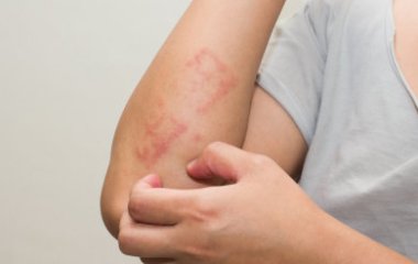 Чорні плями виявилися ознакою розвитку найпоширенішого виду раку