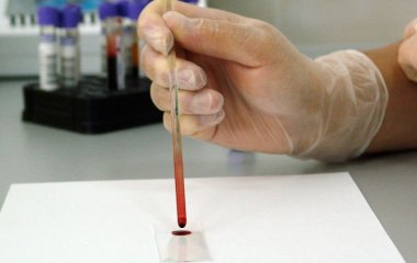 Прорив в онкології: один аналіз крові може виявити десятки видів раку на ранній стадії