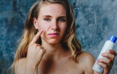 Алергія на косметику: які симптоми та як лікувати