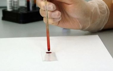 Как понять, что у вас повышен холестерин