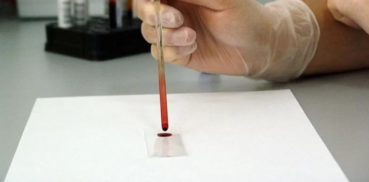 Как понять, что у вас повышен холестерин