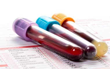 Дефіцит заліза: як зрозуміти, що він у вас є і чим заповнити