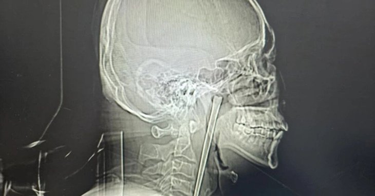Чоловік 8 років жив із металевою паличкою в горлі: лікарі дістали 12-сантиметровий предмет