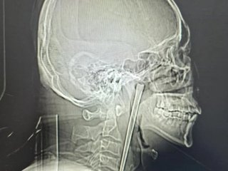 Чоловік 8 років жив із металевою паличкою в горлі: лікарі дістали 12-сантиметровий предмет