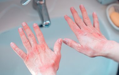 Які хвороби можна розпізнати за станом пахв
