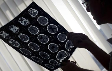 Онколог назвав перші ознаки раку головного мозку