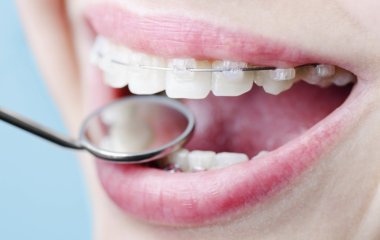 Установка брекетів – ефективний спосіб виправлення неправильного зубного прикусу