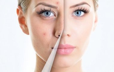 Как избавиться от акне после 30: советы косметологов